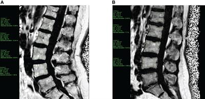 Myosteatosis and bone marrow adiposity are not associated among postmenopausal women with fragility fractures